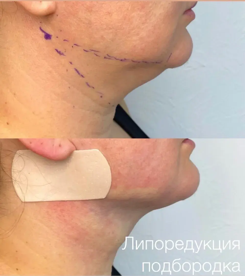 Липоредукция подбородка
