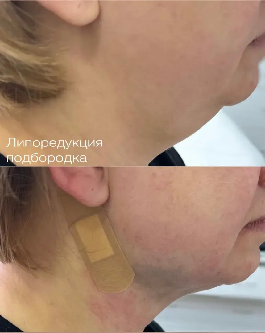 Липоредукция подбородка
